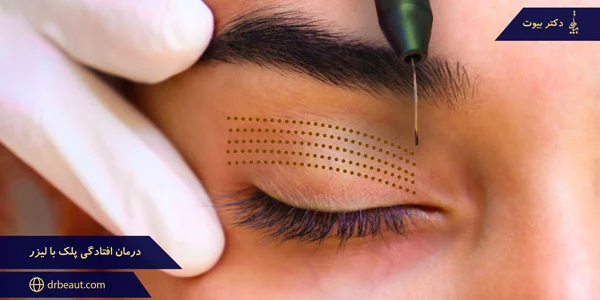 Treatment-of-drooping-eyelids-with-laser